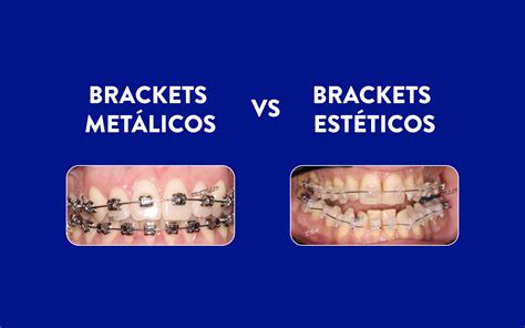 Diferencias entre brackets estéticos y brackets metálicos